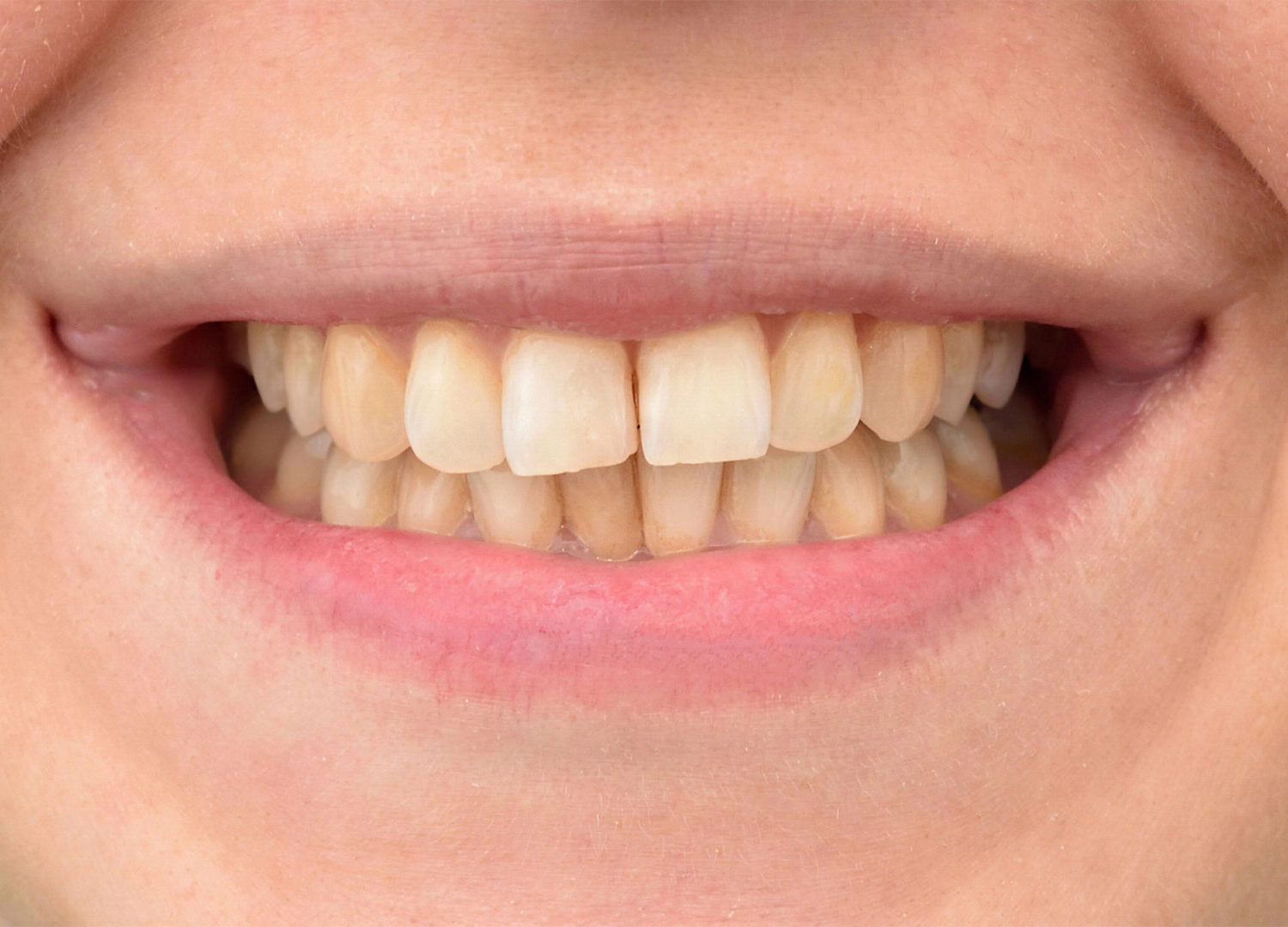 Teeth Whitening Before