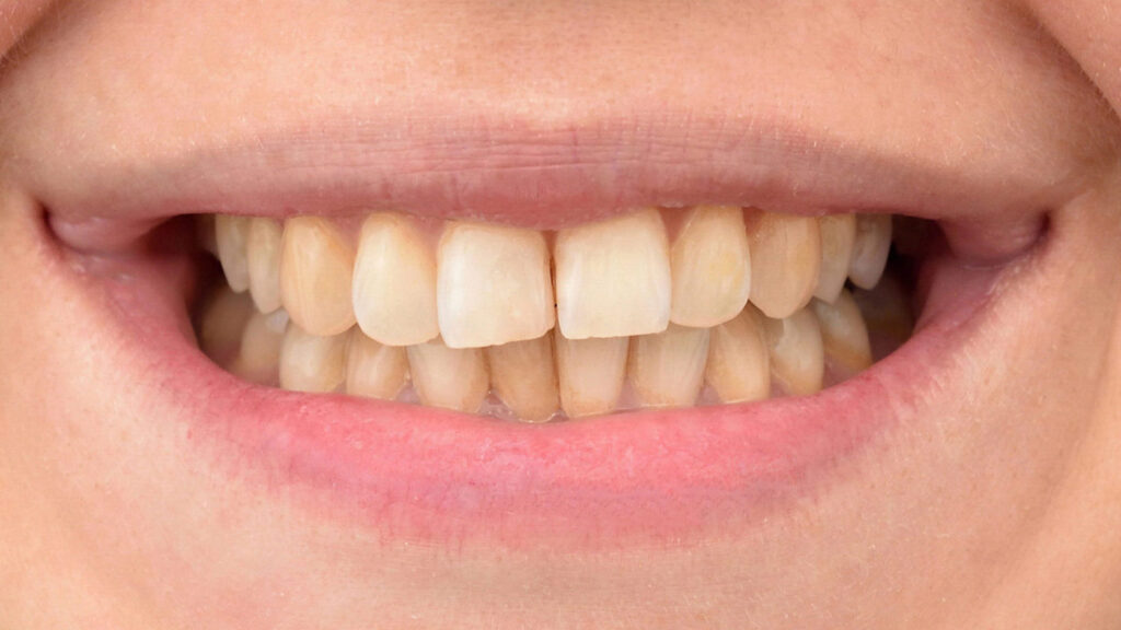 Teeth Whitening Before