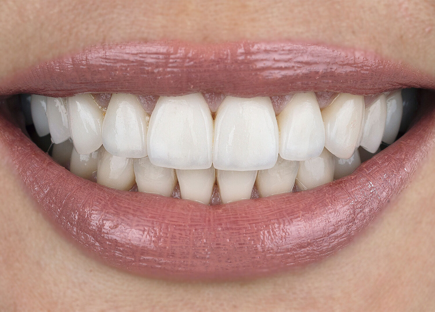 After Dental Veneers