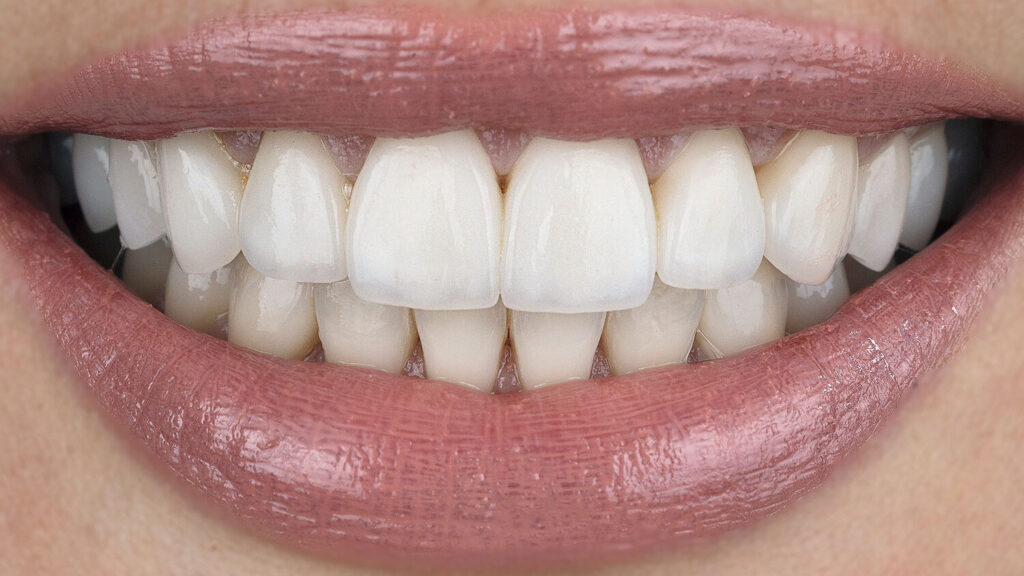 After Dental Veneers