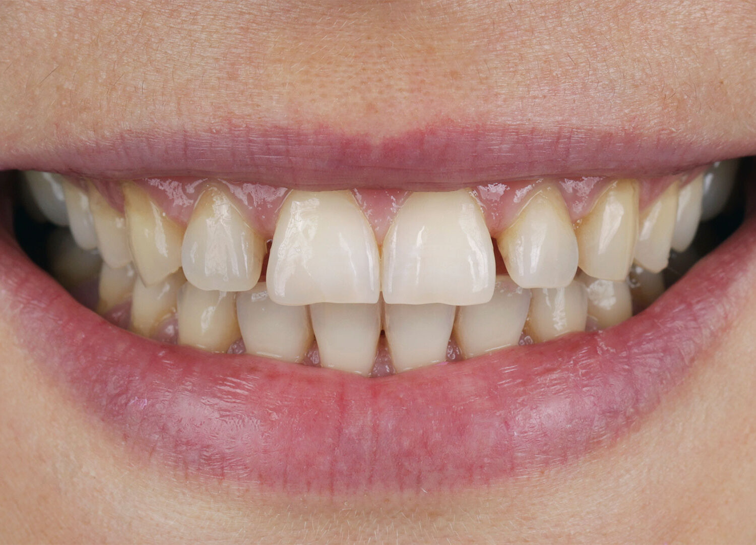 Before Dental Veneers