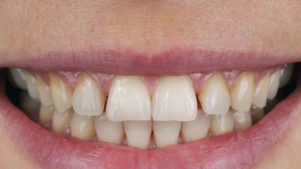 Before Dental Veneers