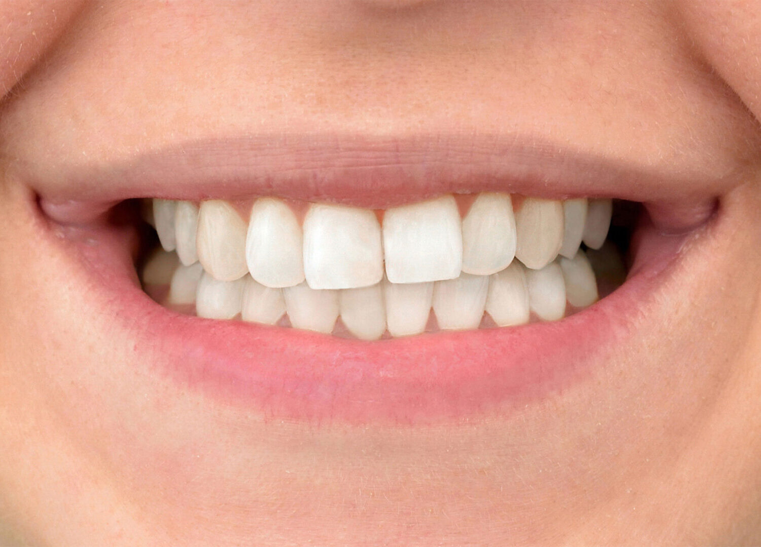 Teeth Whitening After