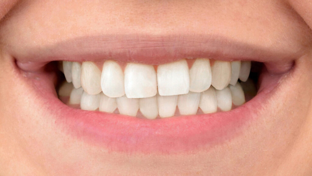 Teeth Whitening After