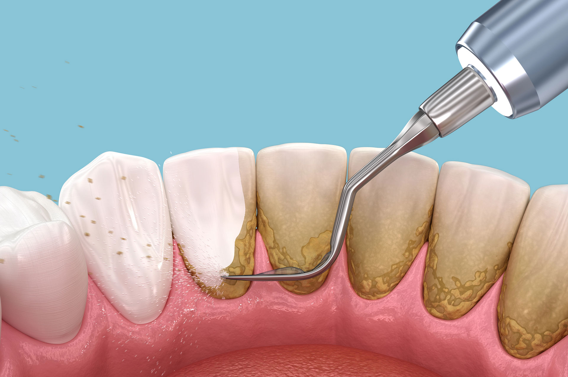 Deep Cleaning and Root Planing Periodontal Therapy