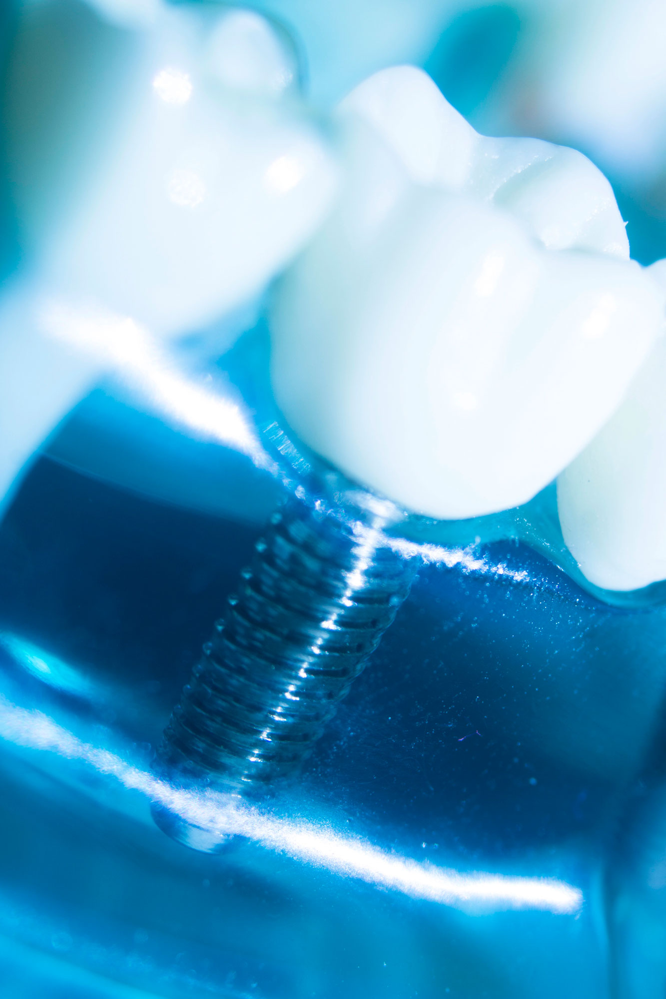 Dental Implants at Oneco Smiles