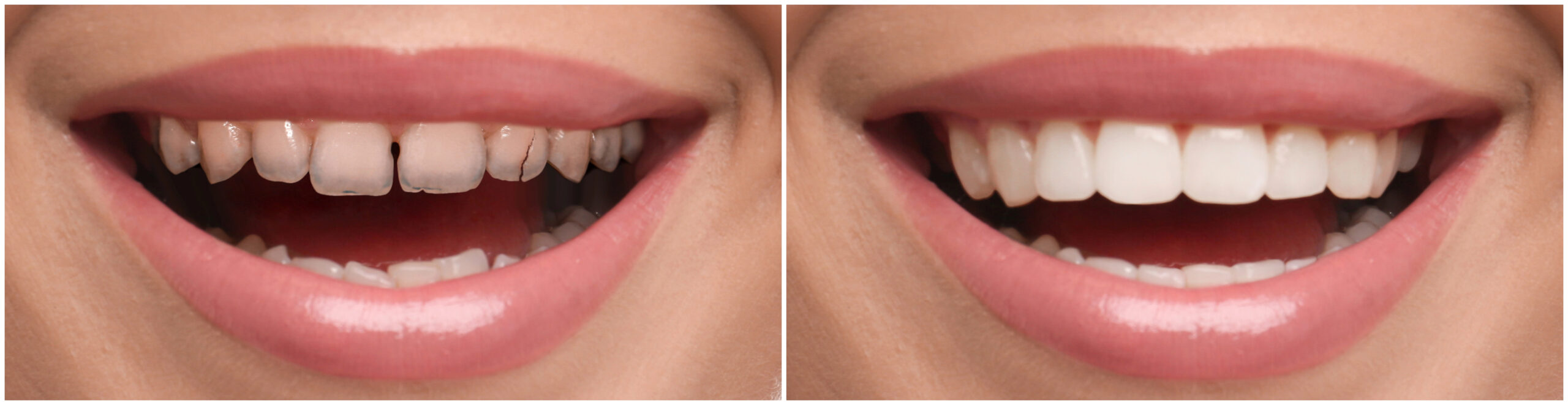 Before and After Smile Makeover by Professional Dentist