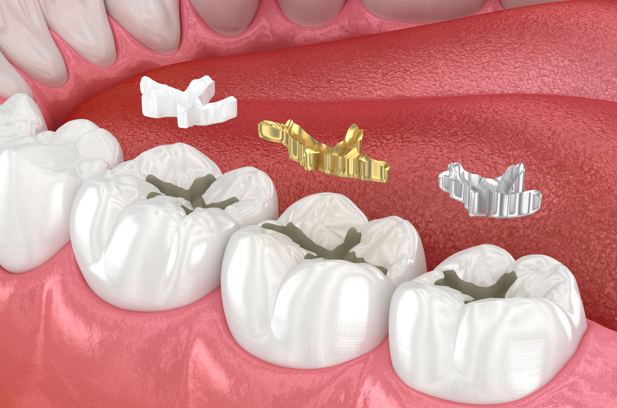Fillings by Oneco Smiles General and Cosmetic Dentistry
