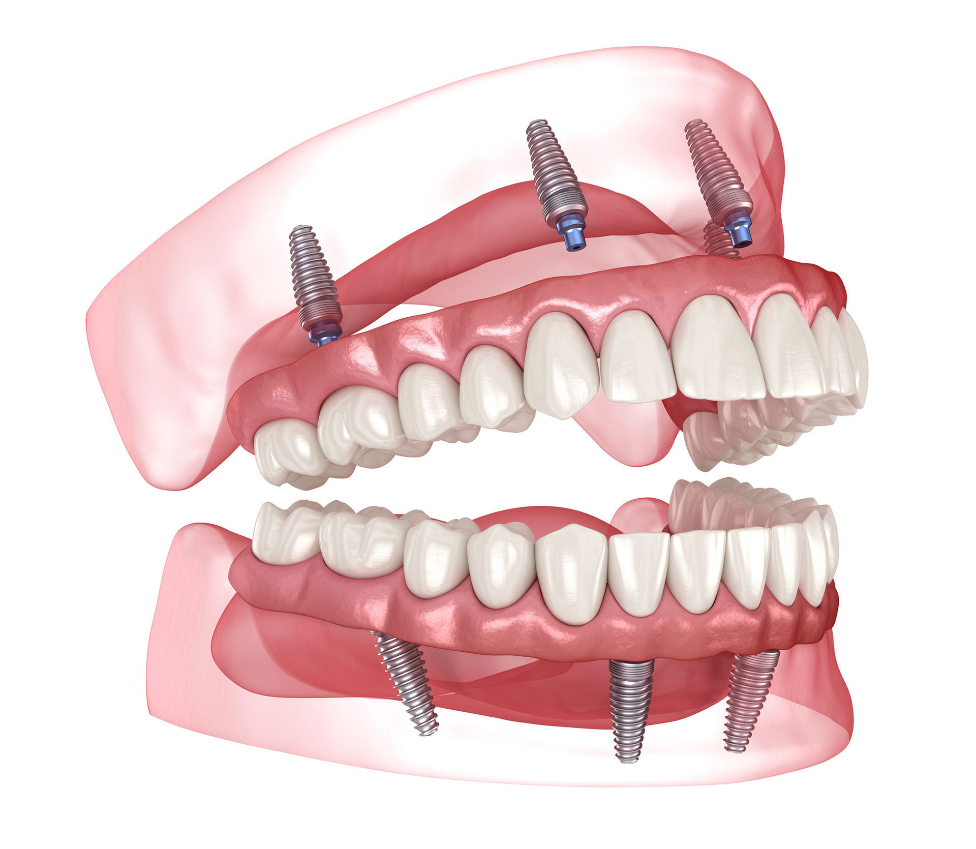 implant supported dentures