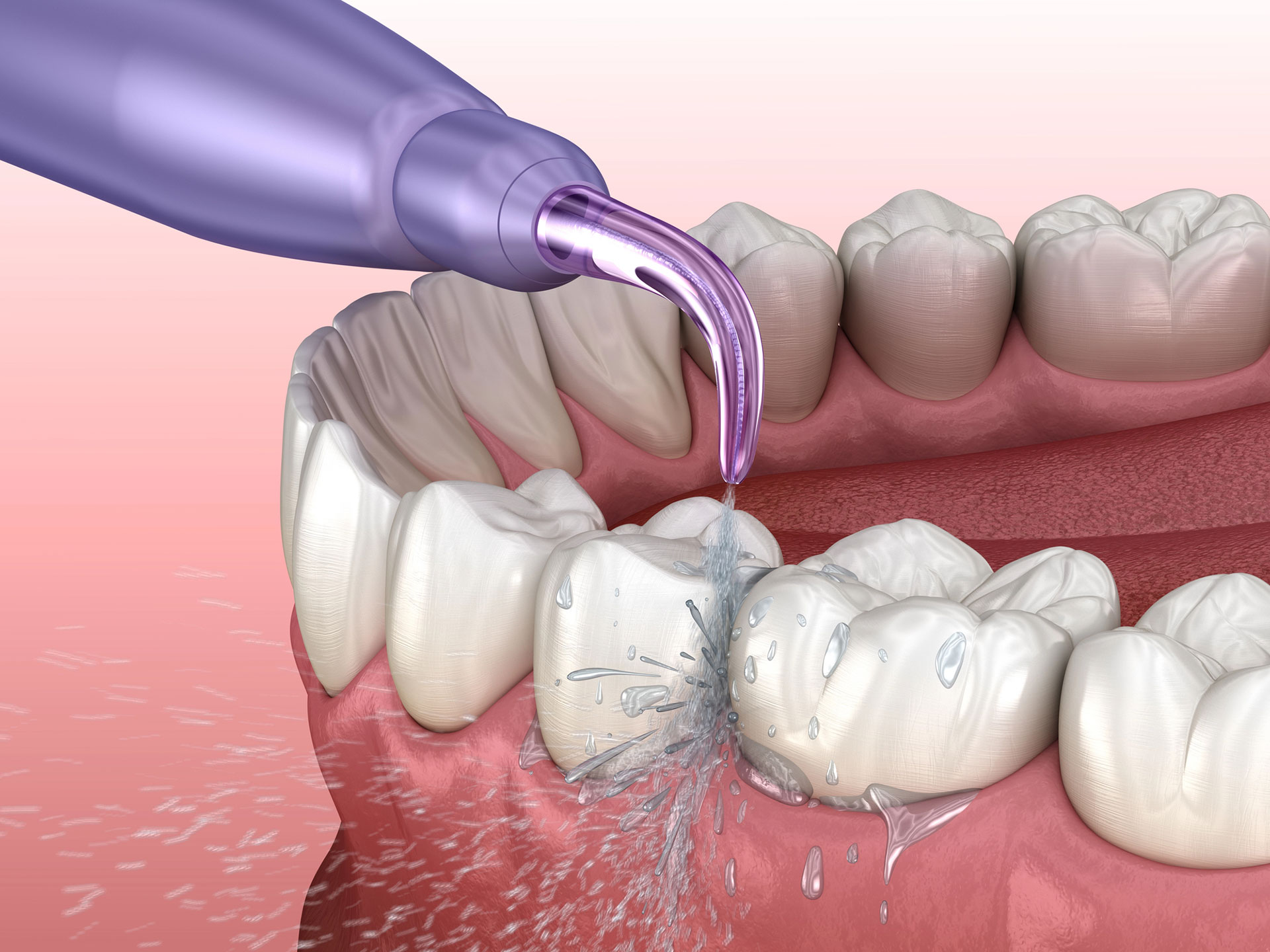 periodontal therapy ongoing maintenance
